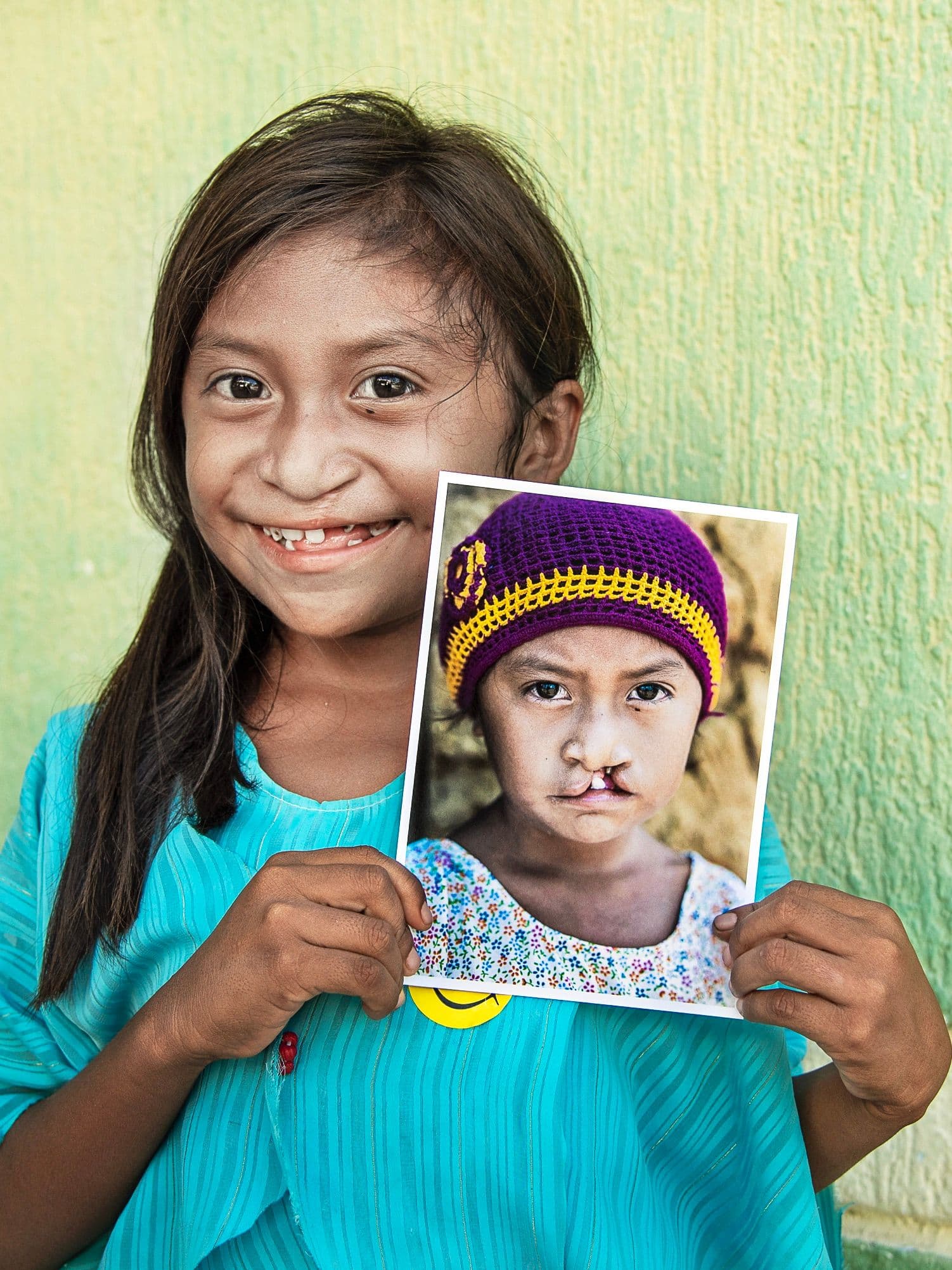 Flicka före och efter käk-gomspaltsoperation